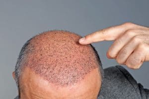 hair-transplant-royalty-free-image-164653183-1547124473